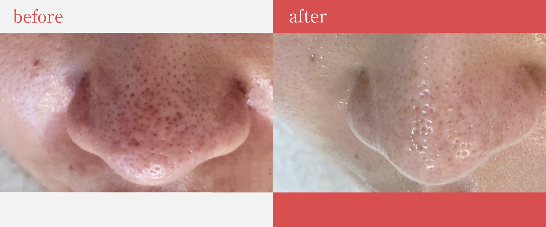 毛穴ケア専門サロンミシア　改善事例